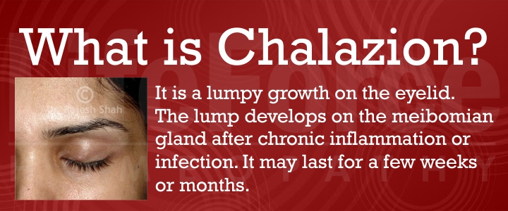 What is Chalazion?